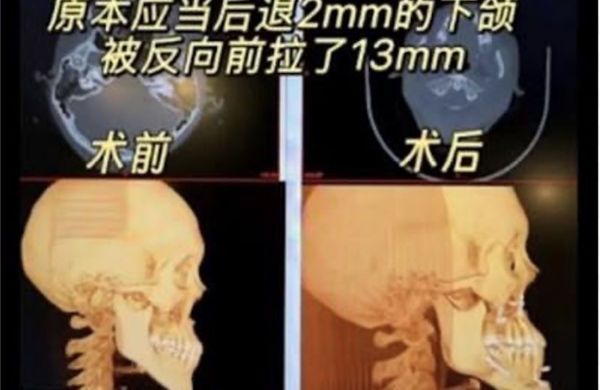 Cô gái Trung Quốc bị biến dạng khuôn mặt sau phẫu thuật chỉnh hàm