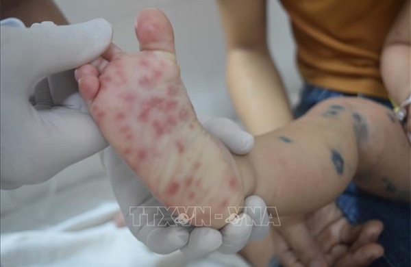 Bệnh tay chân miệng có xu hướng gia tăng