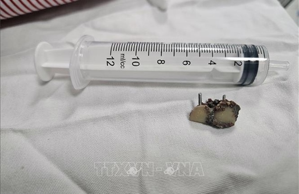 Nội soi lấy thành công 2 răng giả tồn tại trong phổi bệnh nhân hơn 20 năm