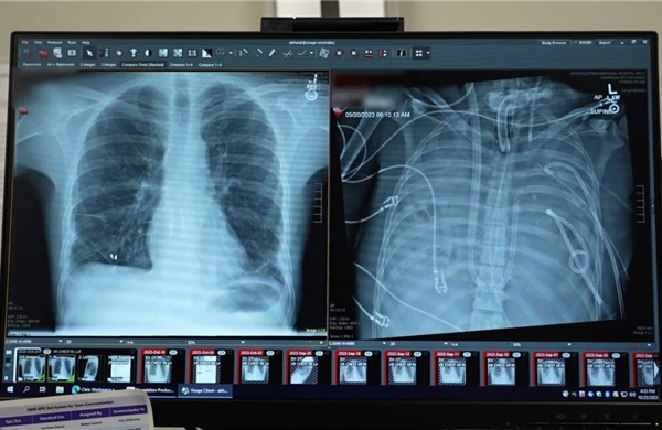 UAE lần đầu tiên triển khai cắt thùy phổi ít xâm lấn bằng robot