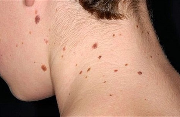Cuba: Chuẩn bị thử nghiệm lâm sàng thuốc điều trị ung thư da mới