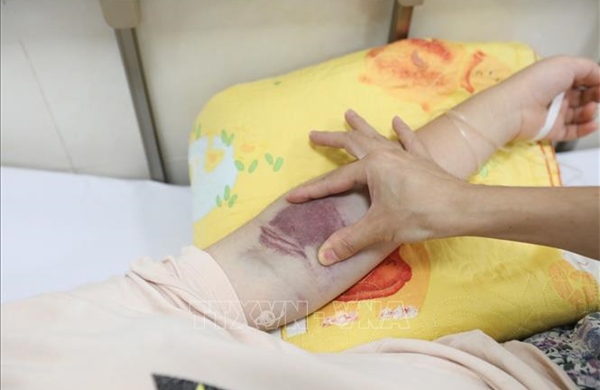 Số ca mắc sốt xuất huyết tăng nhanh tại phố núi Bảo Lộc