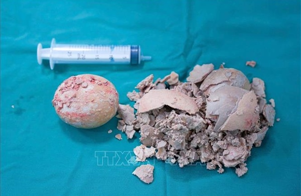 Lấy thành công viên sỏi &#39;khổng lồ&#39; nằm trong cơ thể người bệnh gần 30 năm