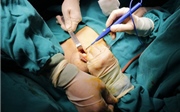 Cứu sống thai phụ bị viêm ruột thừa sắp vỡ và có triệu chứng sinh non Cứu sống thai phụ bị viêm ruột thừa sắp vỡ và có triệu chứng sinh non