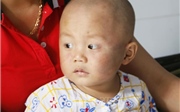 Bảo mẫu tát liên tục vào mặt, bé trai chấn thương phần mềm Bảo mẫu tát liên tục vào mặt, bé trai chấn thương phần mềm