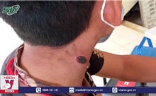 Bệnh than là bệnh truyền nhiễm cấp tính nguy hiểm lây từ động vật sang người