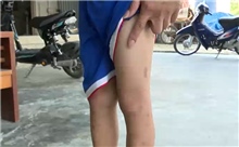 Bọ chét cắn gây mẩn ngứa lây lan diện rộng ở Hà Tĩnh